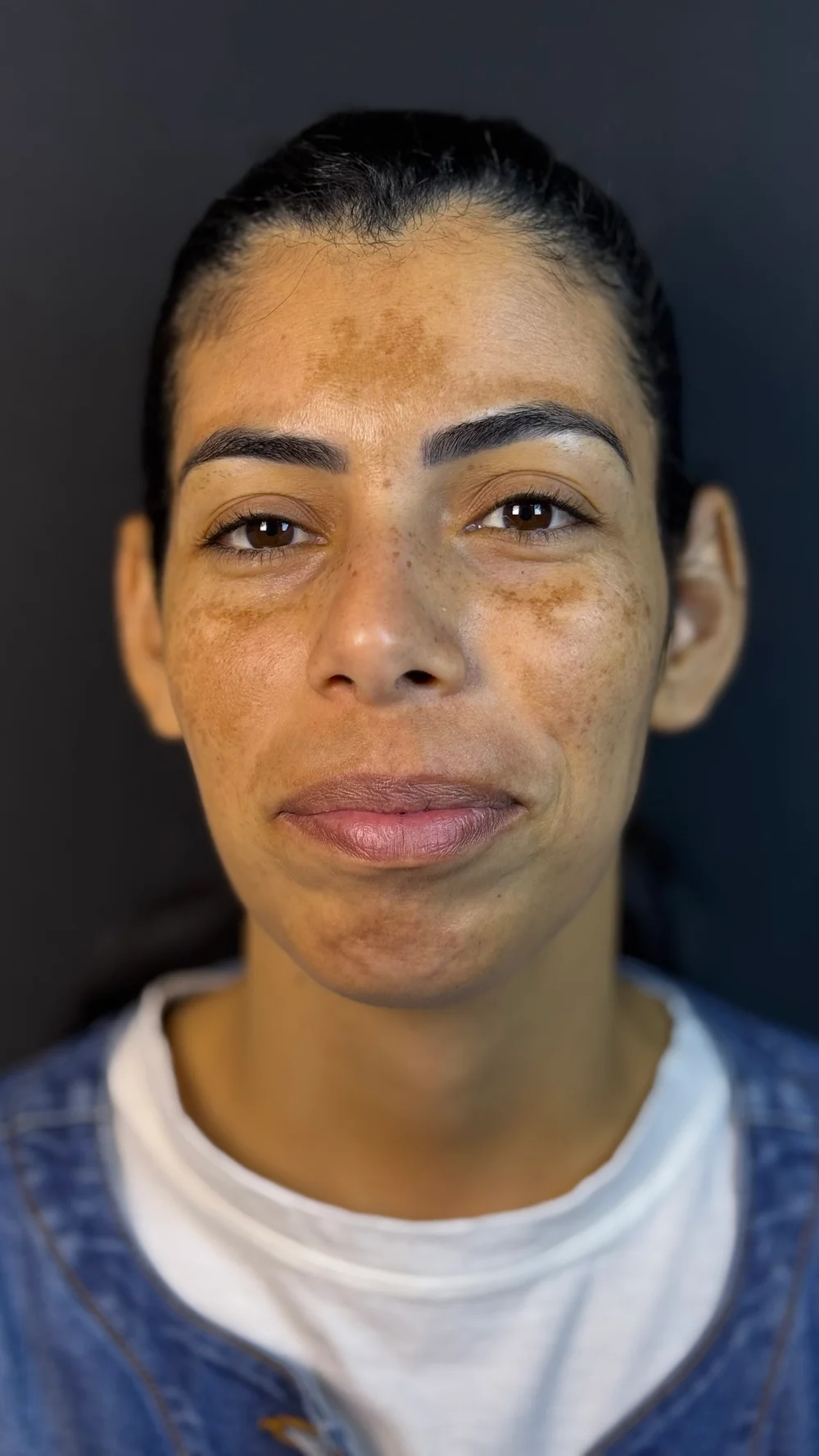 Antes do tratamento de melasma realizado por Camila Borges