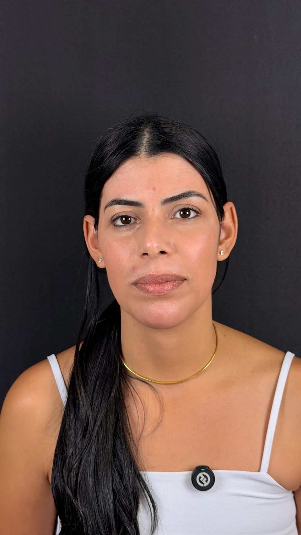 Depois do tratamento de melasma realizado por Camila Borges